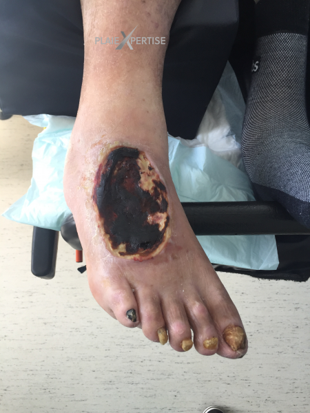 Fichier:Cou de pied35.png