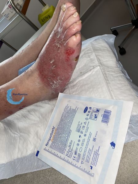 Fichier:Dermite d'irritation149.jpg