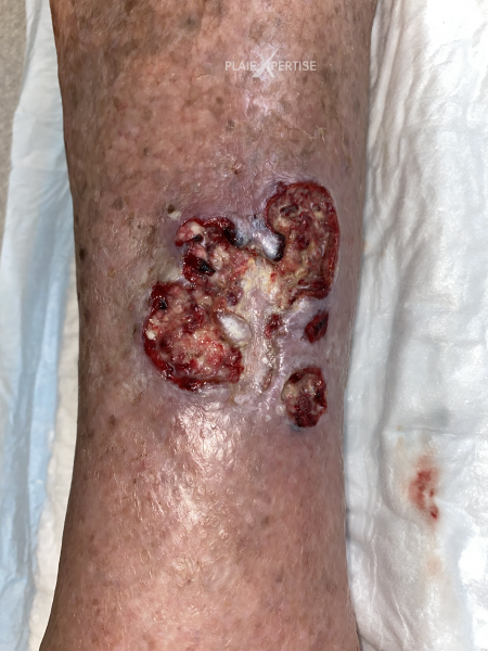 Fichier:Pyoderma gangrenosum23.png