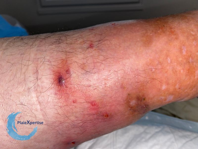 Fichier:Pyoderma gangrenosum56.jpg