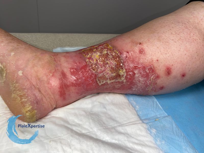 Fichier:Pyoderma gangrenosum60.jpg