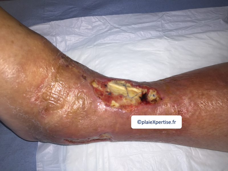 Fichier:Tendon nécrotique humide38.png
