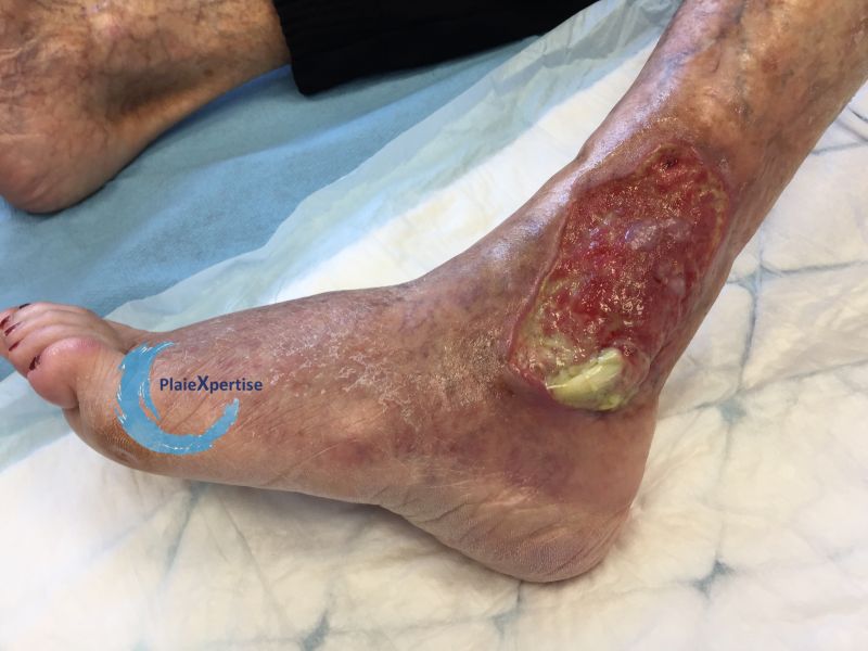 Fichier:Tendon nécrotique humide51.jpg