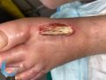 Tendon normal40.jpg
