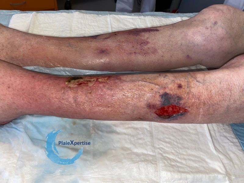 Fichier:Dermatoporose42.jpg