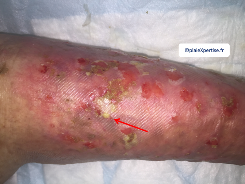 Fichier:Pustules2.png