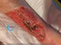Dermite d'irritation238.jpg