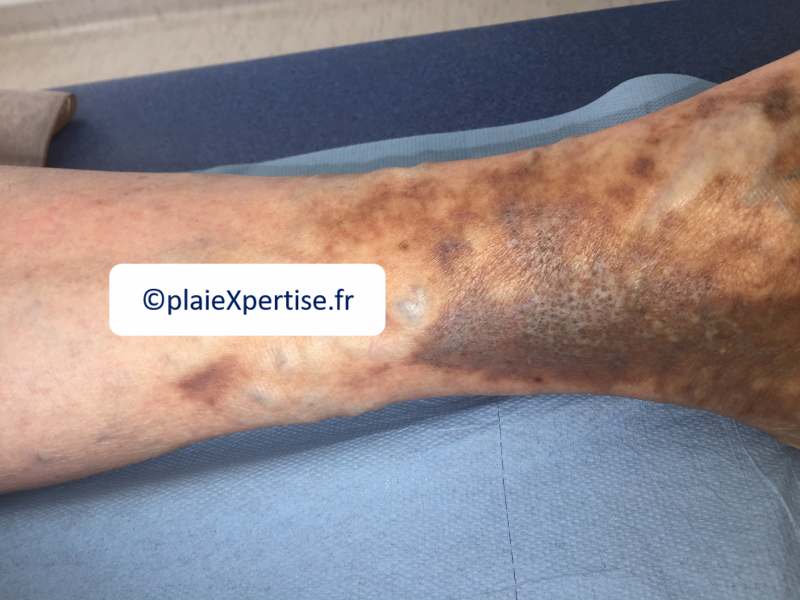 Fichier:Dermiteocre5.png