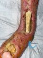 Tendon nécrotique humide69.jpg