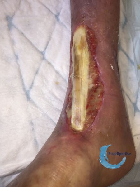 Fichier:Tendon normal31.jpg