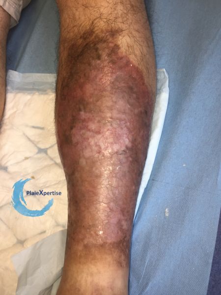 Fichier:Nécrobiose lipoïdique15.jpg