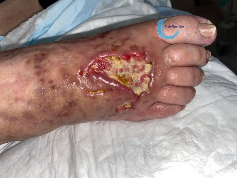 Fichier:Cou de pied96.jpg