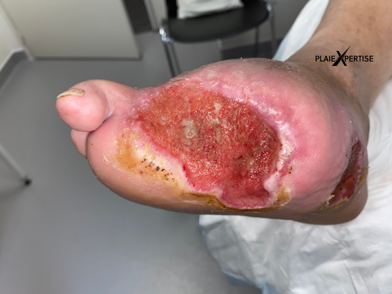Fichier:Pied de Charcot2.png