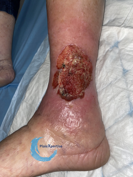 Fichier:Tissu de granulation inflammatoire34.png