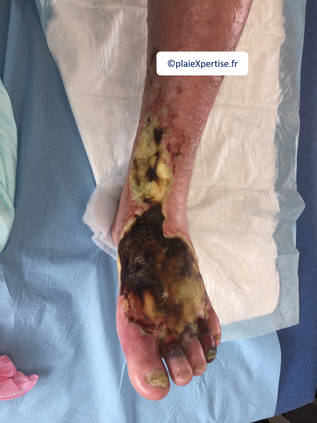 Fichier:Cou de pied22.png