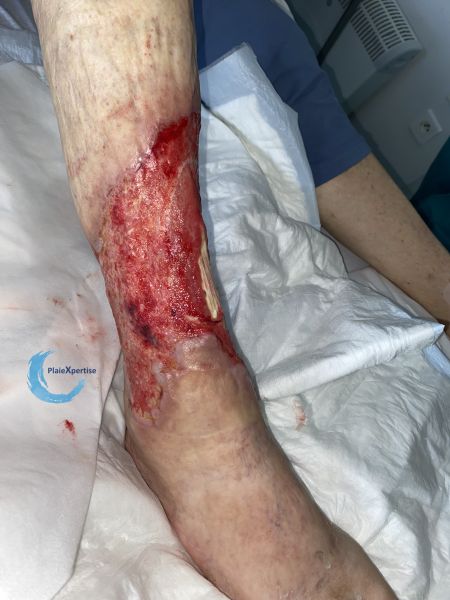 Fichier:Tendon normal49.jpg