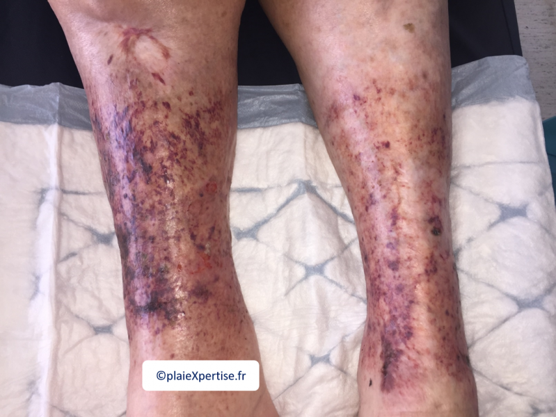 Fichier:Purpura par fragilité capillaire2.png