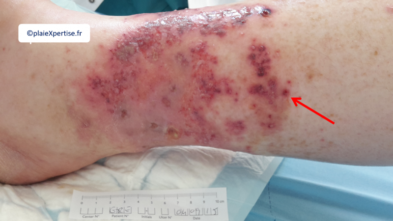 Fichier:Purpura pustuleux3.png