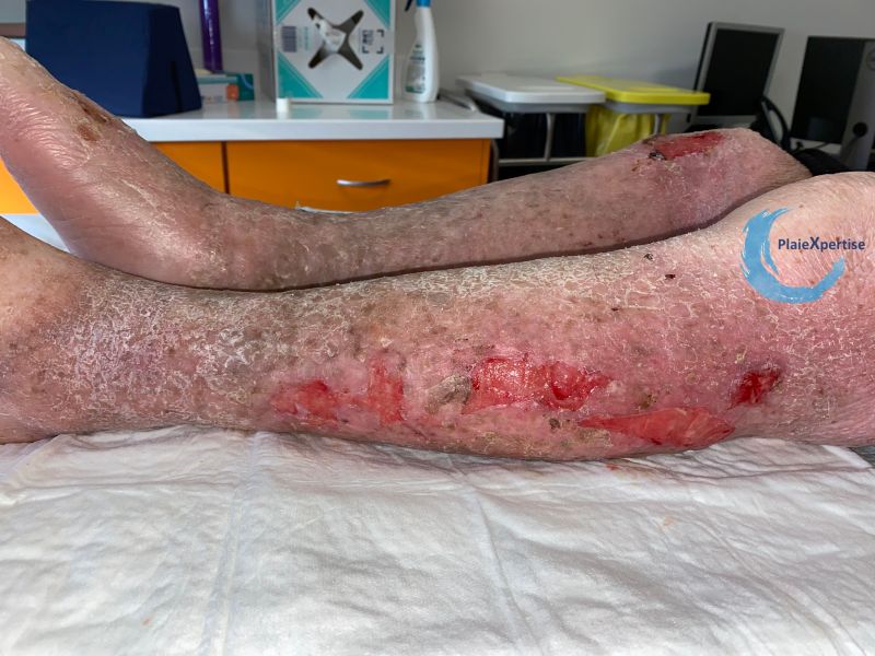Fichier:Eczéma craquelé24.jpg