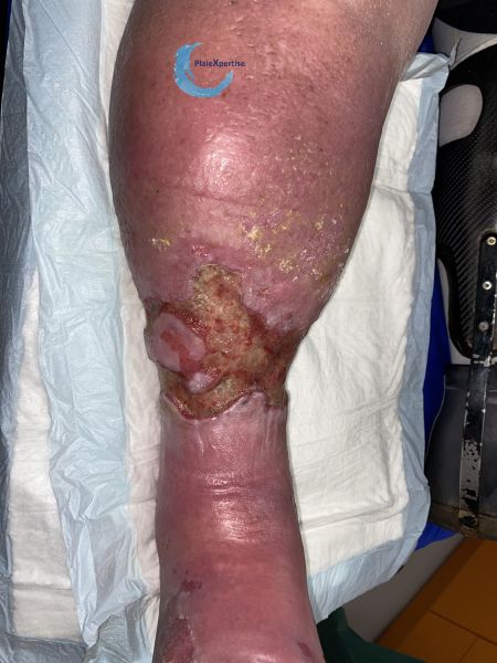 Fichier:Grosses jambes suintantes42.jpg