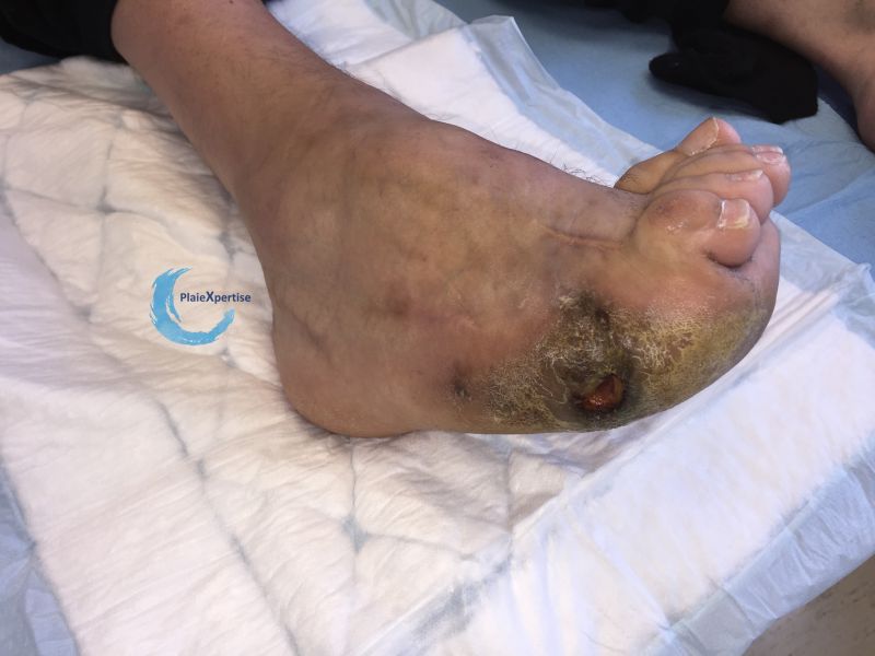 Fichier:Pied de Charcot47.jpg