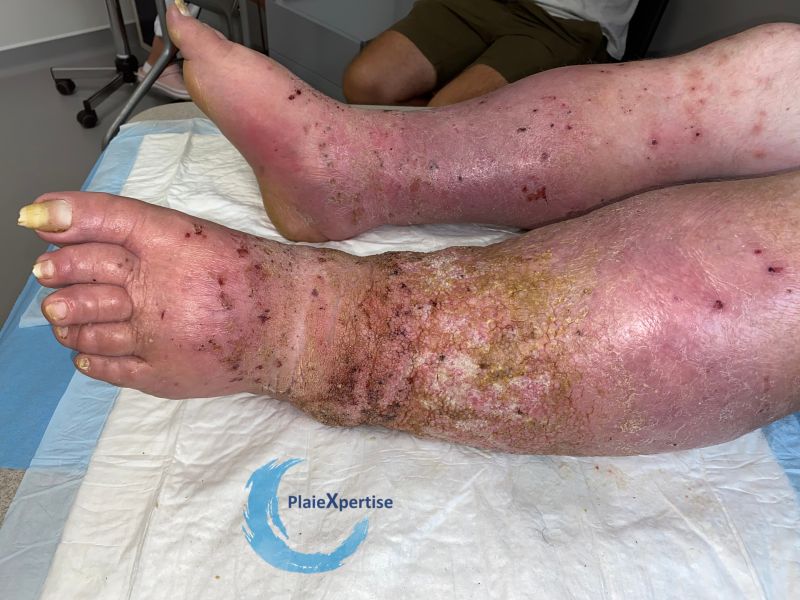 Fichier:Grosses jambes suintantes48.jpg