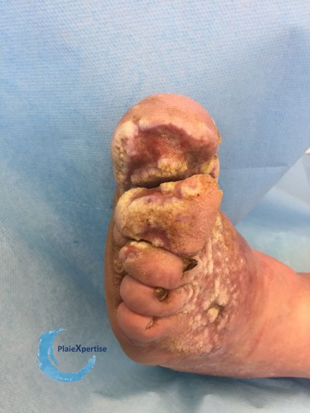 Fichier:Lymphoedème50.jpg