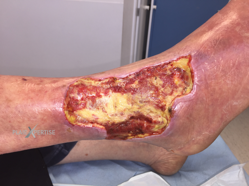 Fichier:Cou de pied37.png