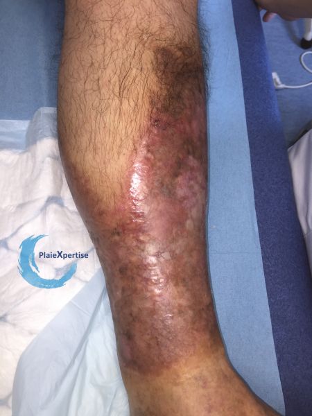 Fichier:Nécrobiose lipoïdique16.jpg
