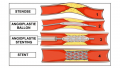 Angioplastie.png