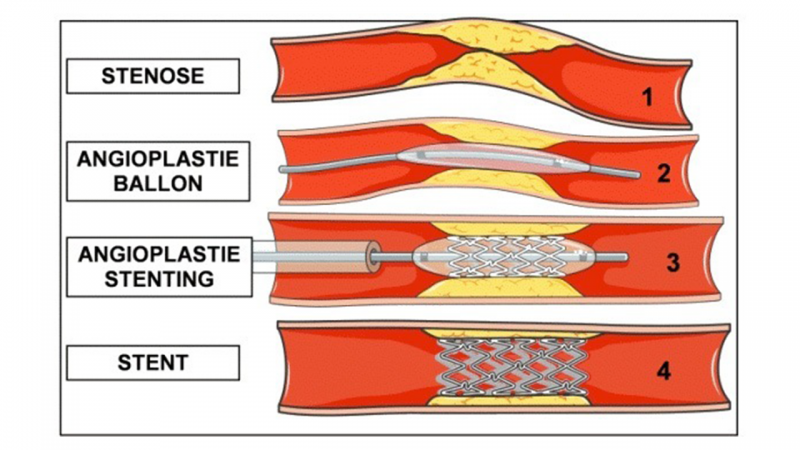 Fichier:Angioplastie.png