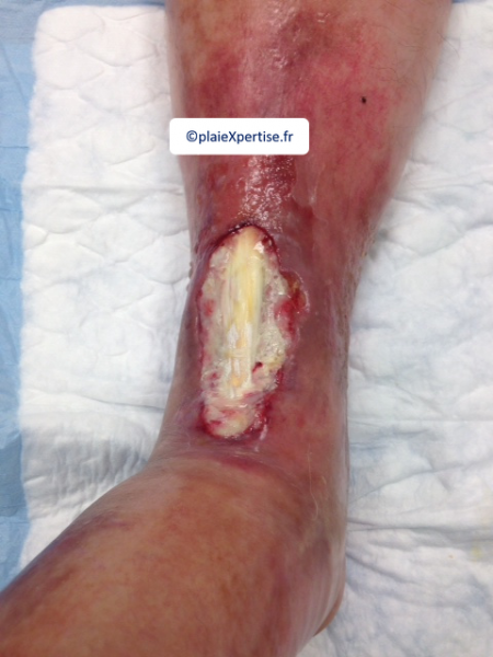 Fichier:Tendon normal18.png