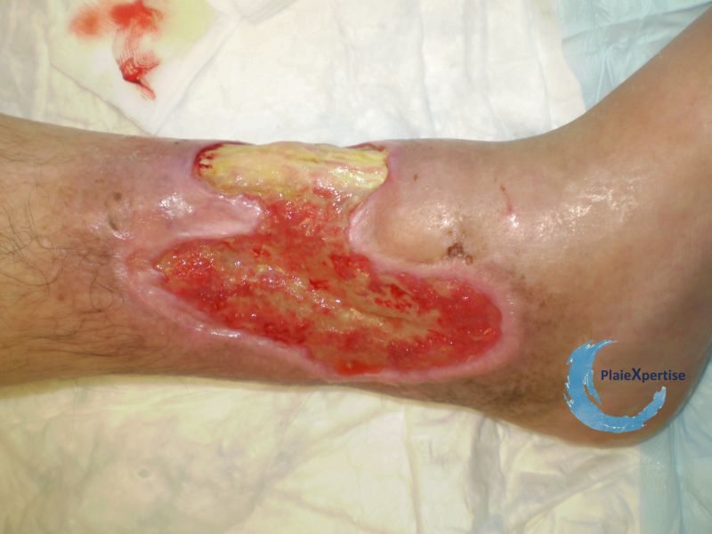Fichier:Tendon normal38.jpg
