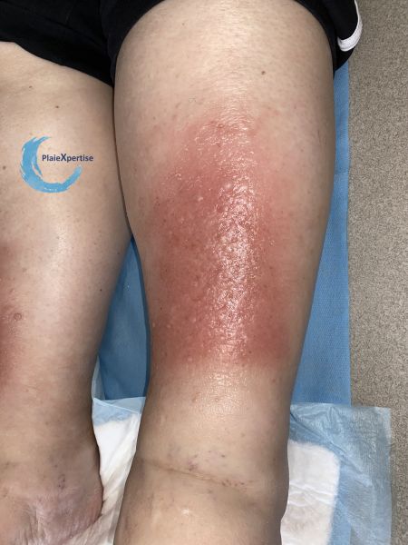 Fichier:Hypodermite chronique68.jpg
