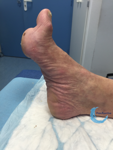 Fichier:Pied de Charcot10.png