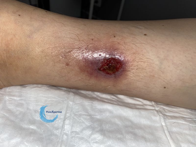 Fichier:Angiodermite typique110.jpg