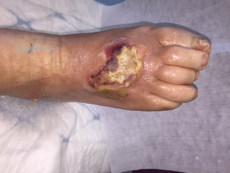 Fichier:Cou de pied40.png