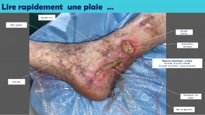 Lire une plaie rapidement.jpg