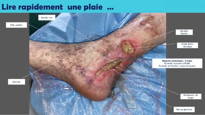 Fichier:Lire une plaie rapidement.jpg
