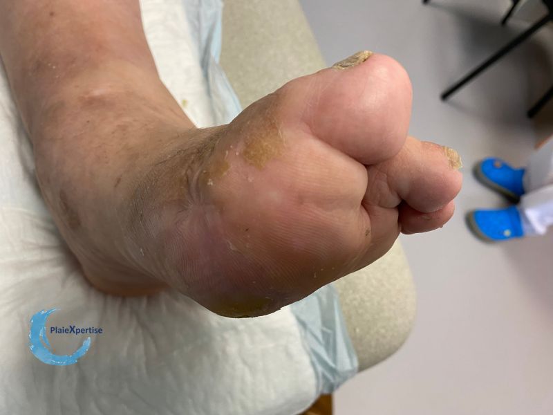 Fichier:Pied de Charcot42.jpg