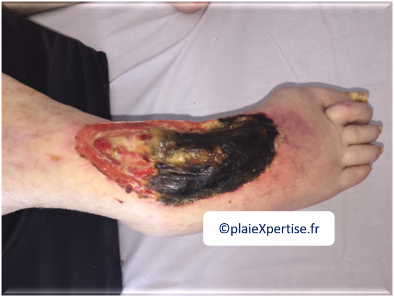 Fichier:Cou de pied4.png