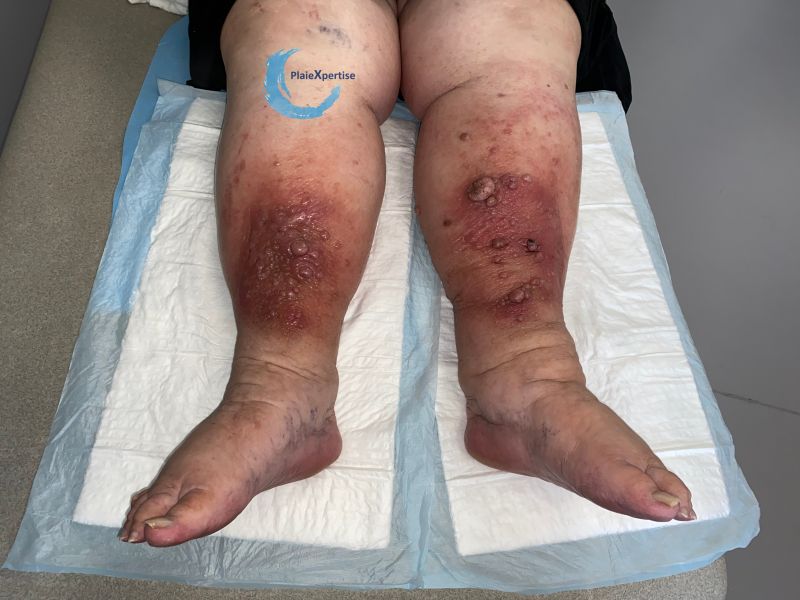 Fichier:Hypodermite chronique72.jpg