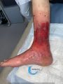 Dermite d'irritation224.jpg