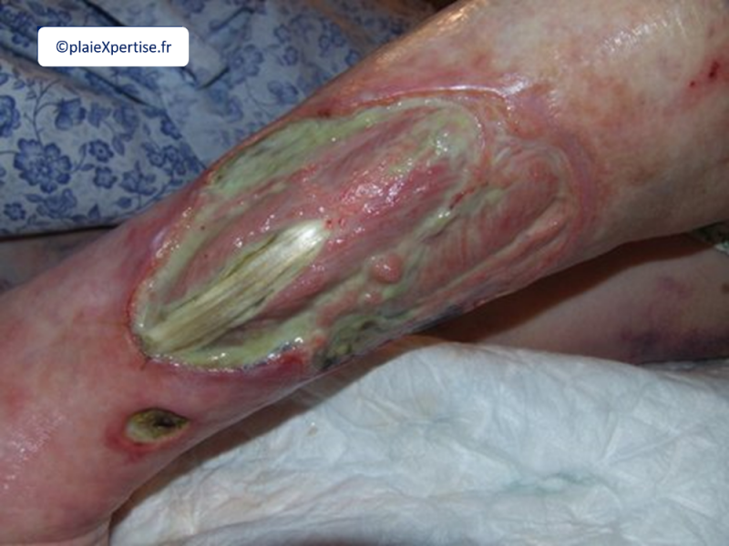 Fichier:Tendon normal5.png