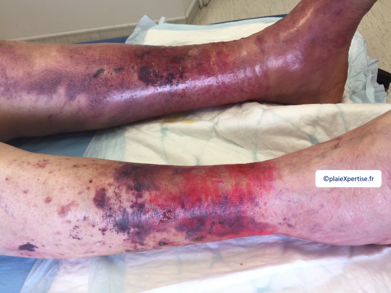 Fichier:Dermatoporose3.png
