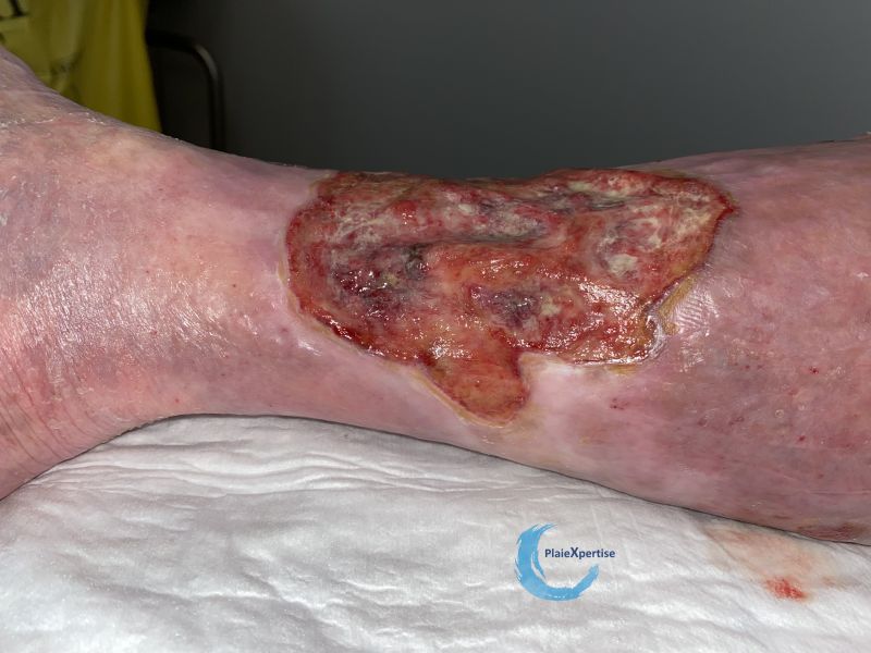 Fichier:Tissu de granulation inflammatoire54.jpg