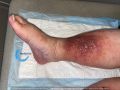 Dermite d'irritation234.jpg