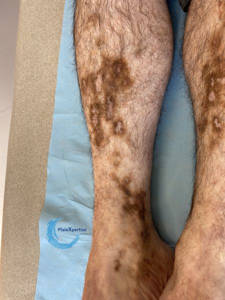 Fichier:Dermiteocre80.jpg