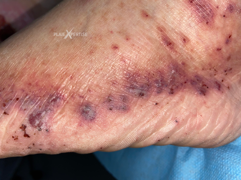 Fichier:Vascularite22.png