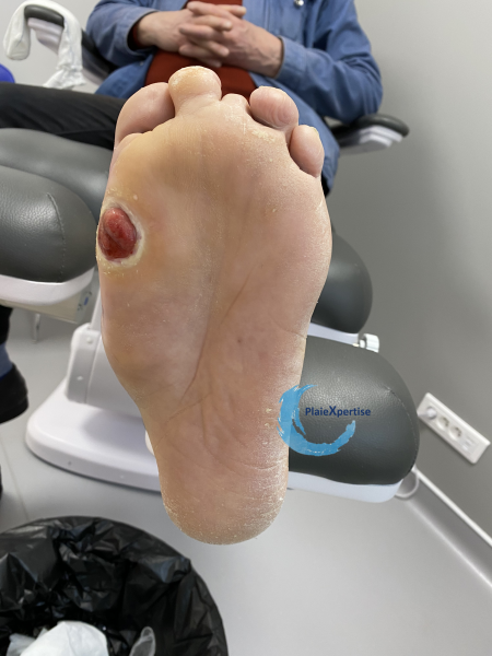 Fichier:Pied de Charcot9.png
